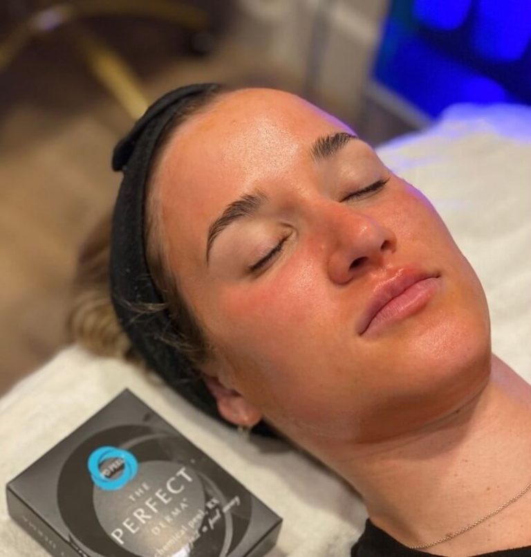 Chemical Peel Treatment Procedure and Results