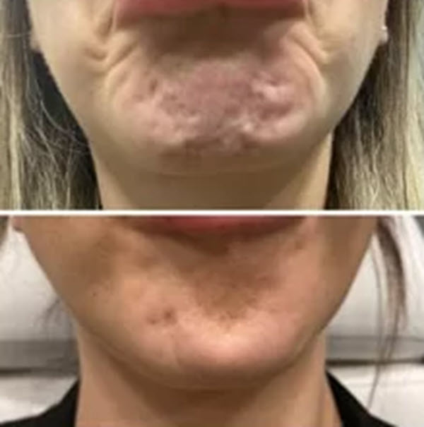 Before and after Botox for chin wrinkles