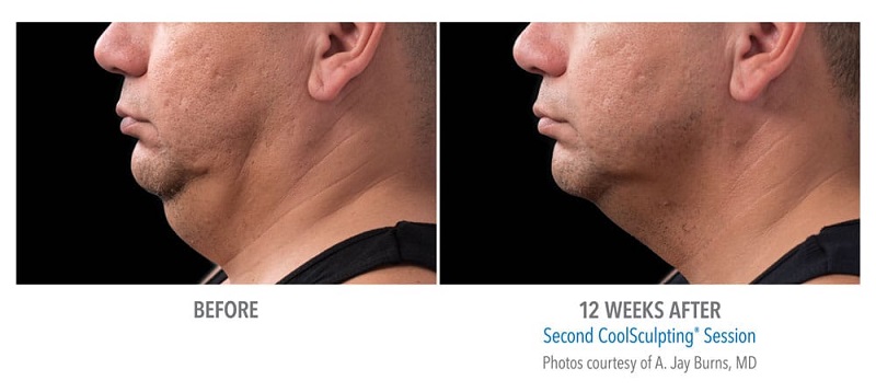 Before and after photos of CoolSculpting chin