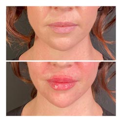 Dermal Fillers - A woman's before and after lip dermal fillers at Vibrant Skin Bar in Phoenix