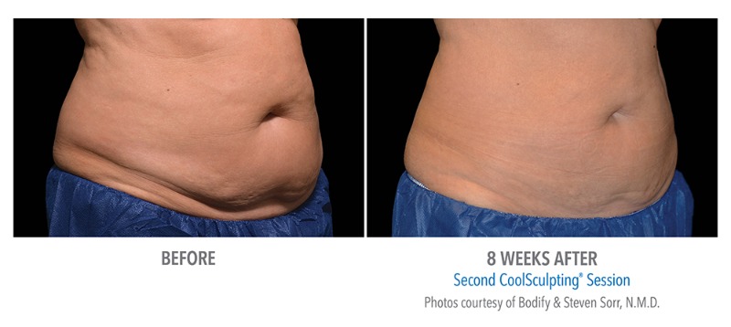 Coolsculpting before and after pictures after 8 weeks.