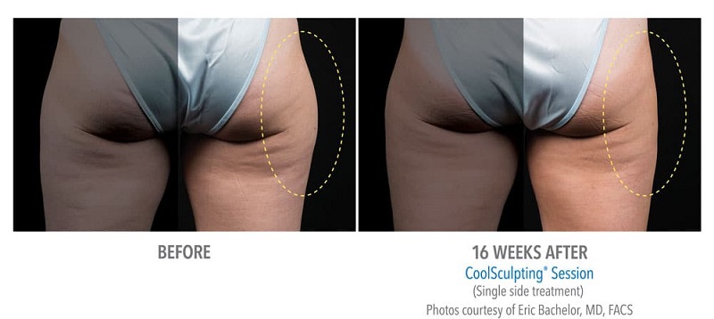 Before and after CoolSculpting for outer thighs