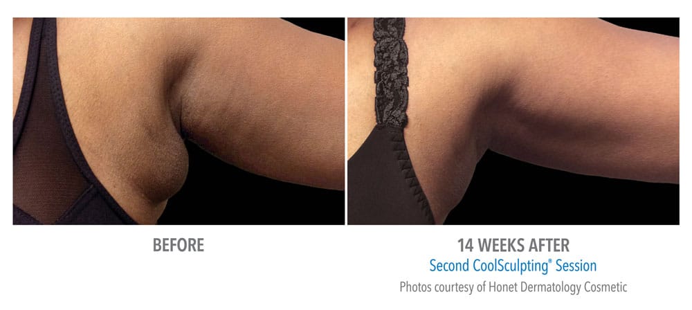 CoolSculpting before and after results