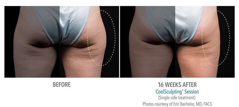 Before and after of CoolSculpting for outer thighs