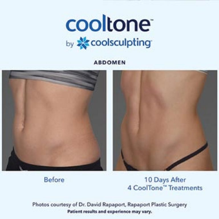 CoolSculpting vs. CoolTone What's the Difference?
