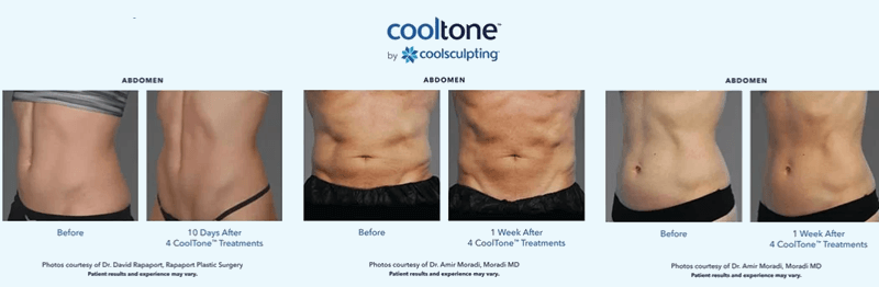 Before and after CoolTone treatments