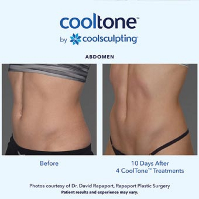 Before and after of CoolTone for the abdomen