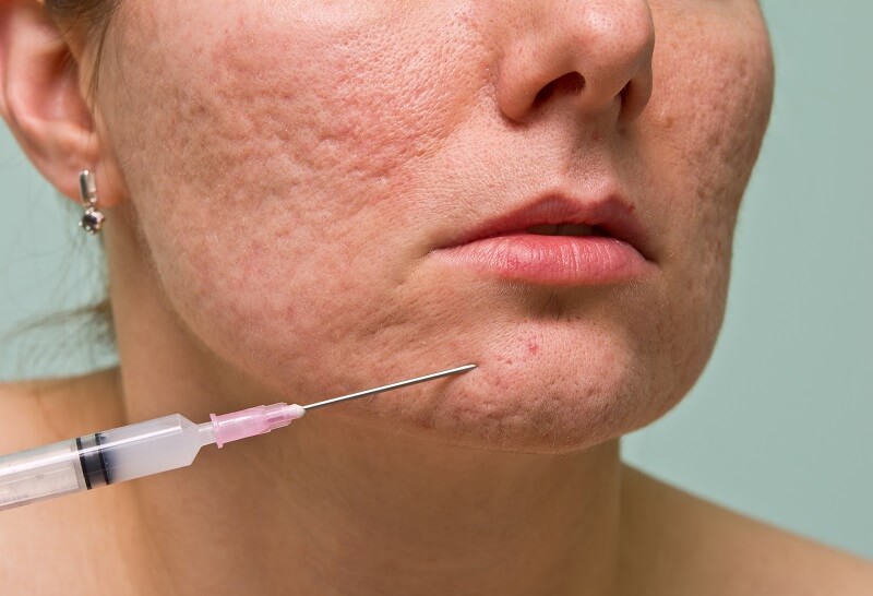 How to Get Rid of Acne Scars Best Treatments for Acne Scars