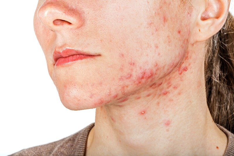 Cysts are severe, inflammatory acne deep under the skin.