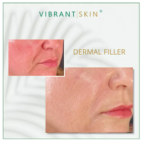 dermal filler treatment for wrinkles above lips