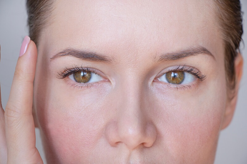 Droopy eyelids after Botox