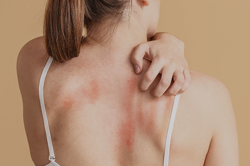 Eczema symptoms