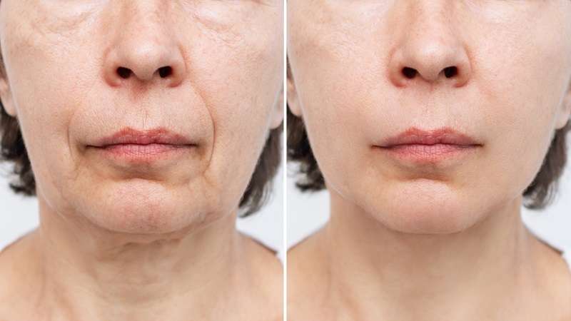 Facelift: before and after image
