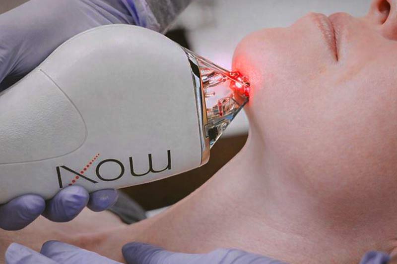 MOXI laser aftercare