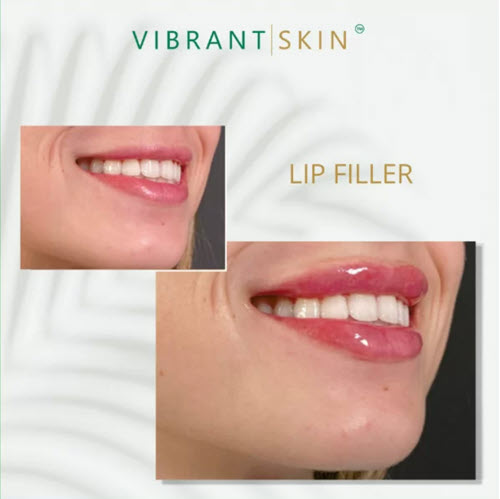 Before and after image of Juvederm filler.