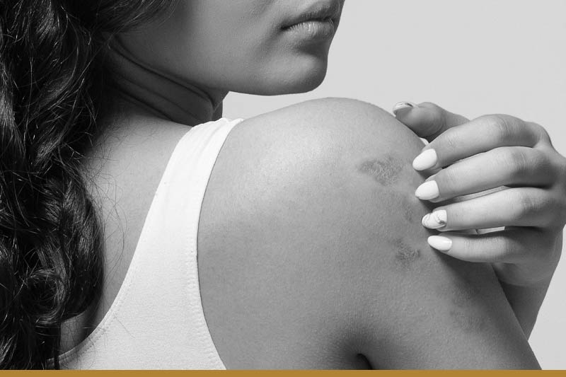 Symptoms of food allergy