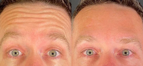 Before and after Botox for forehead wrinkles