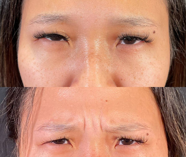 Before and after Botox for frown lines