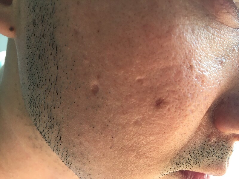 Hypertrophic acne scar example