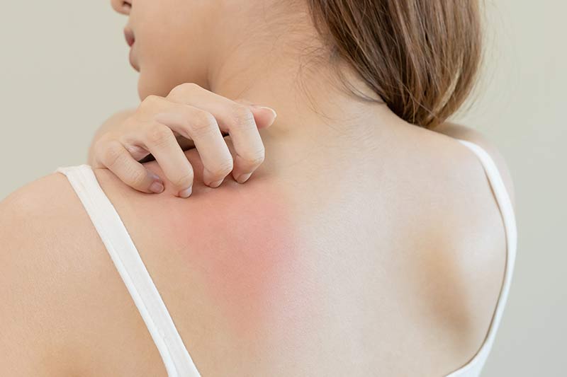 IBS and eczema
