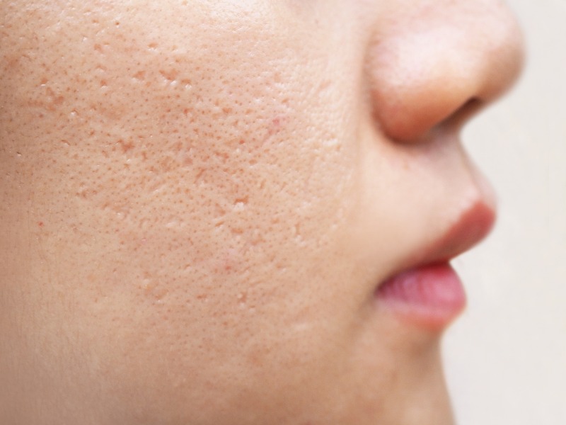 Icepick acne scars example