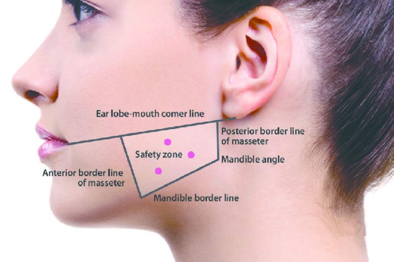 Jaw-Slimming Botox Injection Points