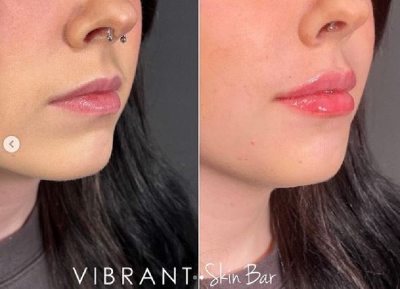 Before and after images of a Juvederm lip filler 