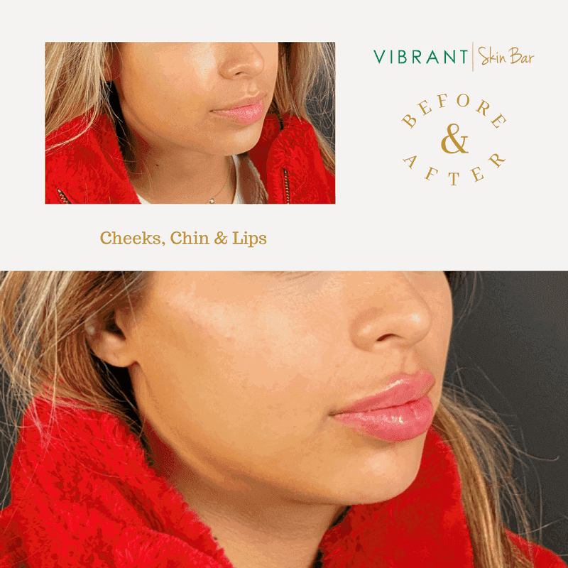 Juvederm and Restylene before and after results
