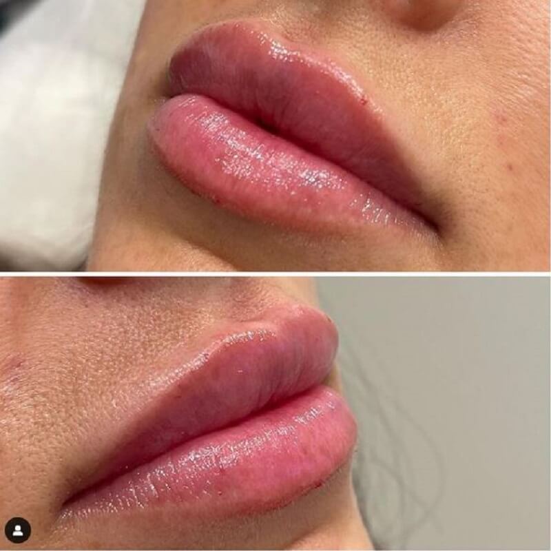 Juvederm for lips' plumpness