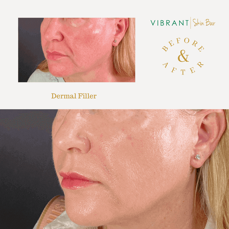 Dermal filler before and after images