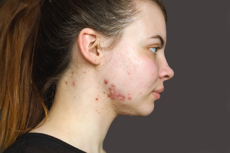 Keloid acne scars example
