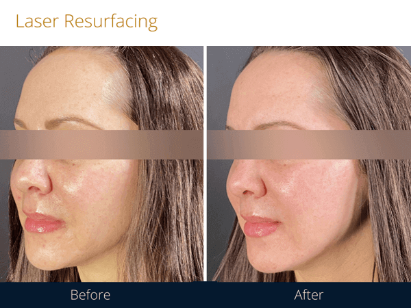 The results before and after laser resurfacing