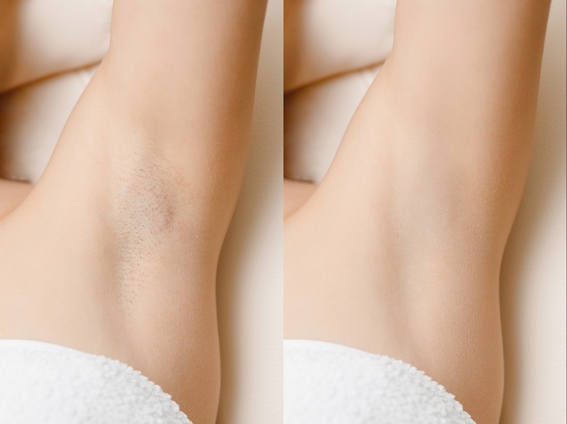 Underarm laser hair removal before and after photo