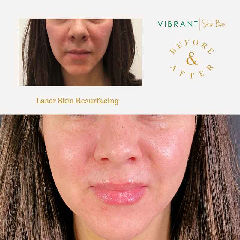 Laser resurfacing before and after