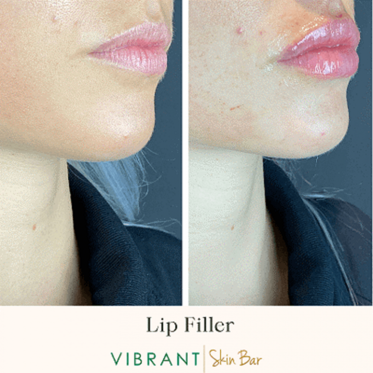 Lip Flip Vs Filler What Are The Differences Between Two Lip Treatments
