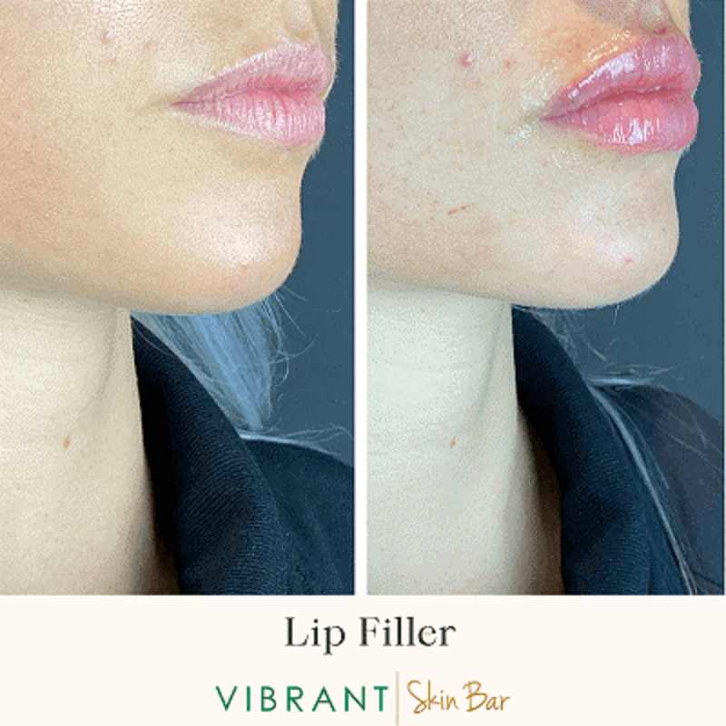 Lip Filler Aftercare: What Not to Do for Optimal Results