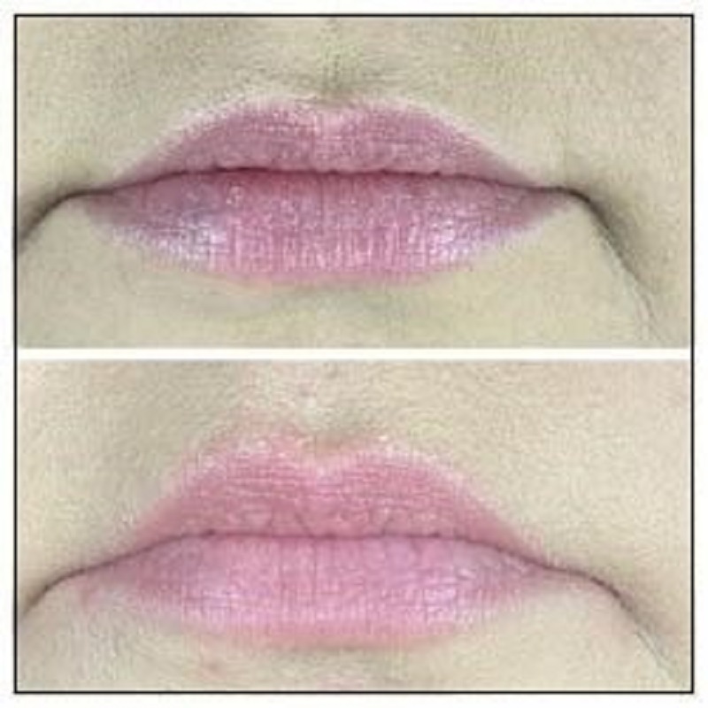 Lip flip before and after results