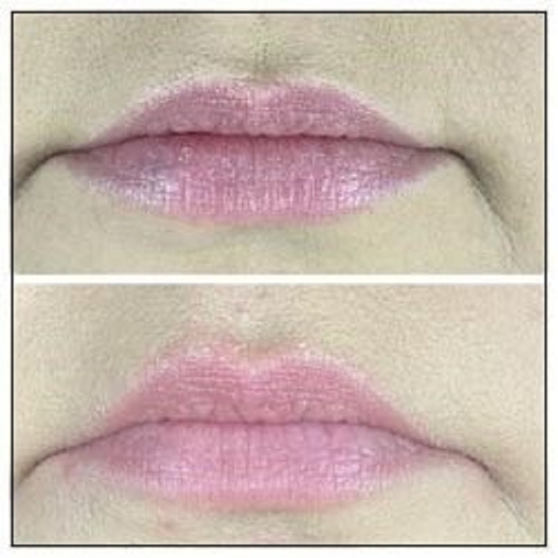 WCC Watson - This client started with the lip flip and then decided to do  filler for longer lasting results! 👄 Lip flip vs lip filler: The lip flip  consists of 4