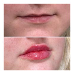 Dermal Fillers - Before and after lip dermal fillers at Vibrant Skin Bar in Phoenix