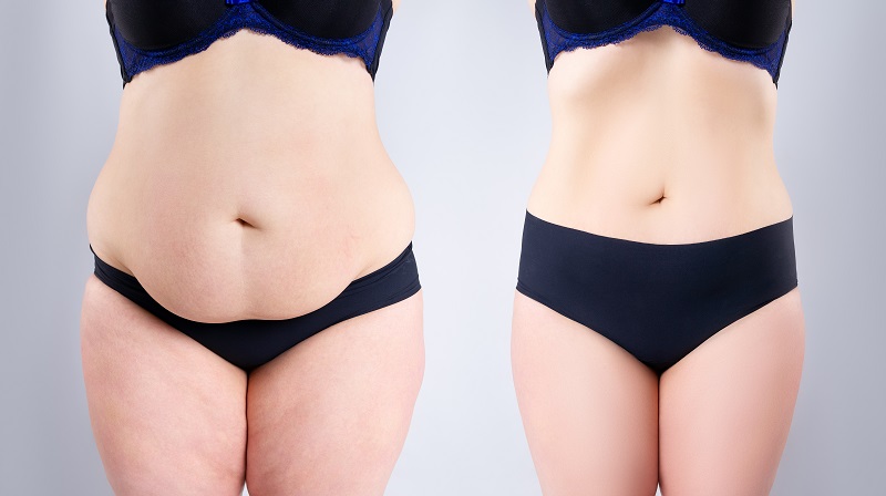 Liposuction: the before and after results