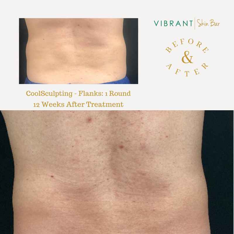 8 MONTH COOL SCULPTING RESULTS, process, recovery, and final results