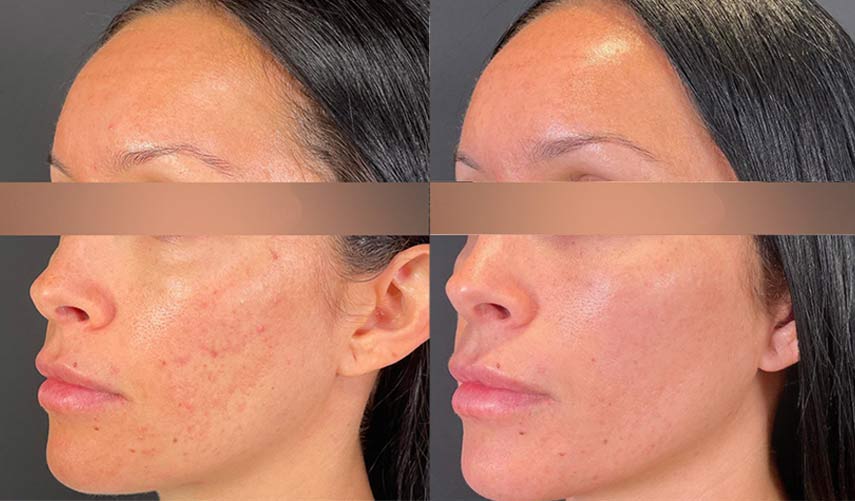 Before and after microneedling