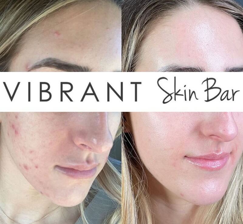 Before and after a microneedling treatment