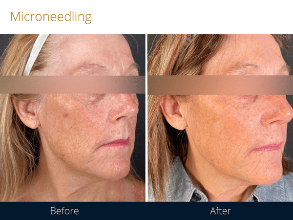 Before and after microneedling