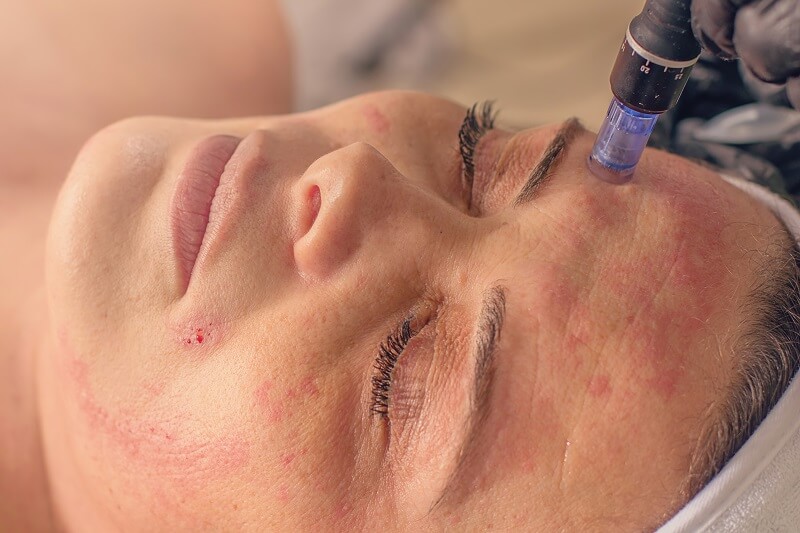 Microneedling is effective for atrophic scars.