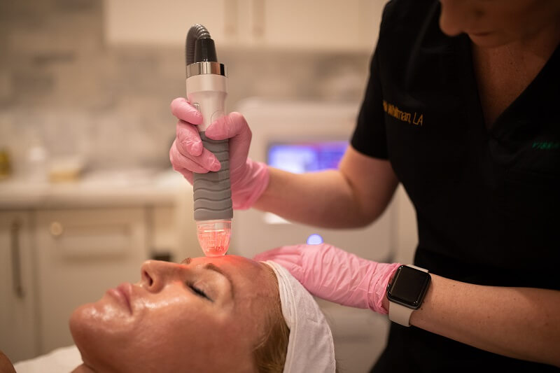 Microneedling procedure