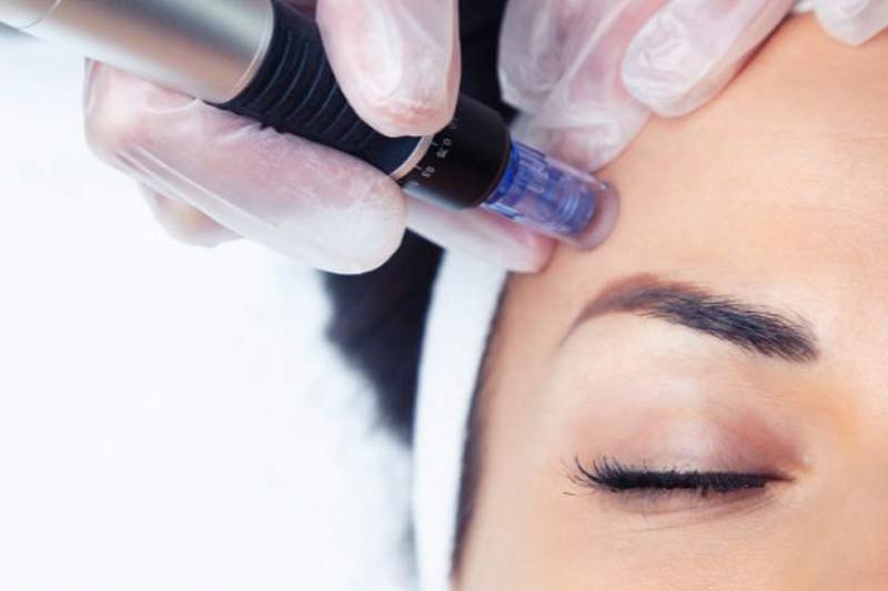 Microneedling for body rejuvenation