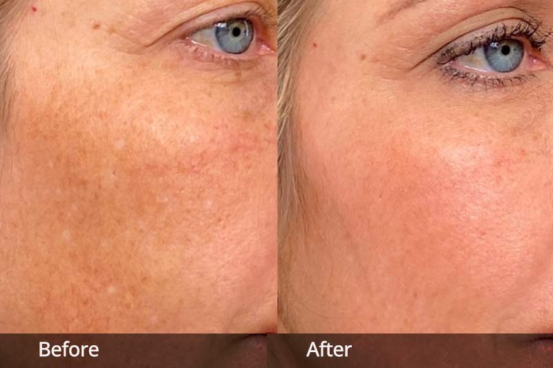 Before and after MOXI laser