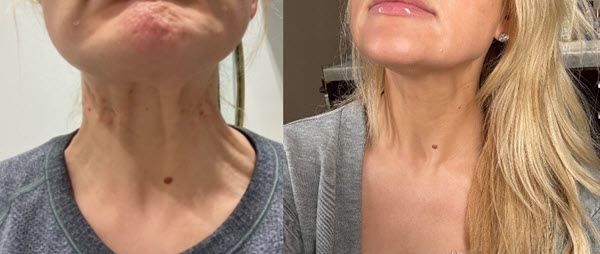 Before and after Botox for neck wrinkles
