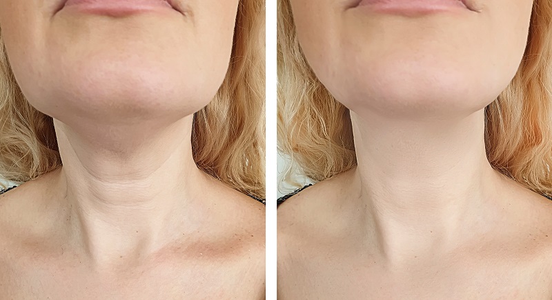 Neck Botox: The Procedure, Risks, Aftercare and Benefits - VibrantSkinBar